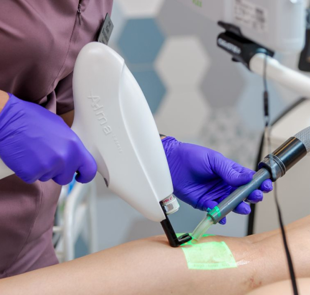 CLaCS (Cryo Laser & Cryo Sclerotherapy)