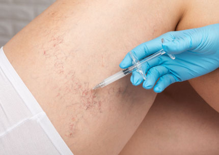 sclerotherapy spider vein treatment process