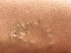 close up of protruding, twisted varicose veins.