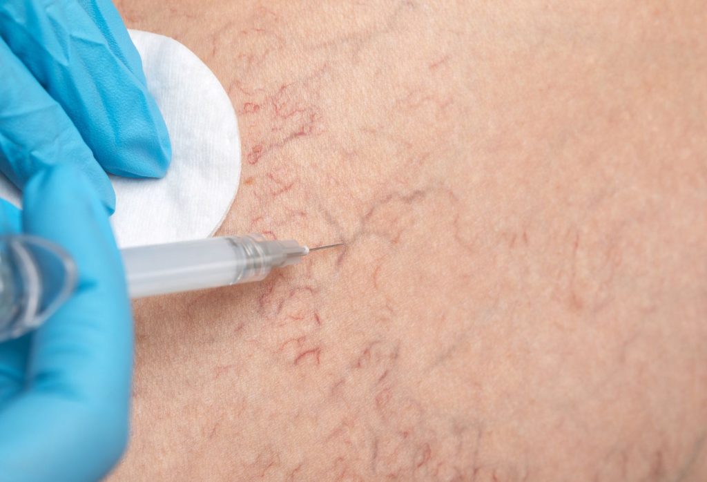 Spider vein treatment with sclerotherapy