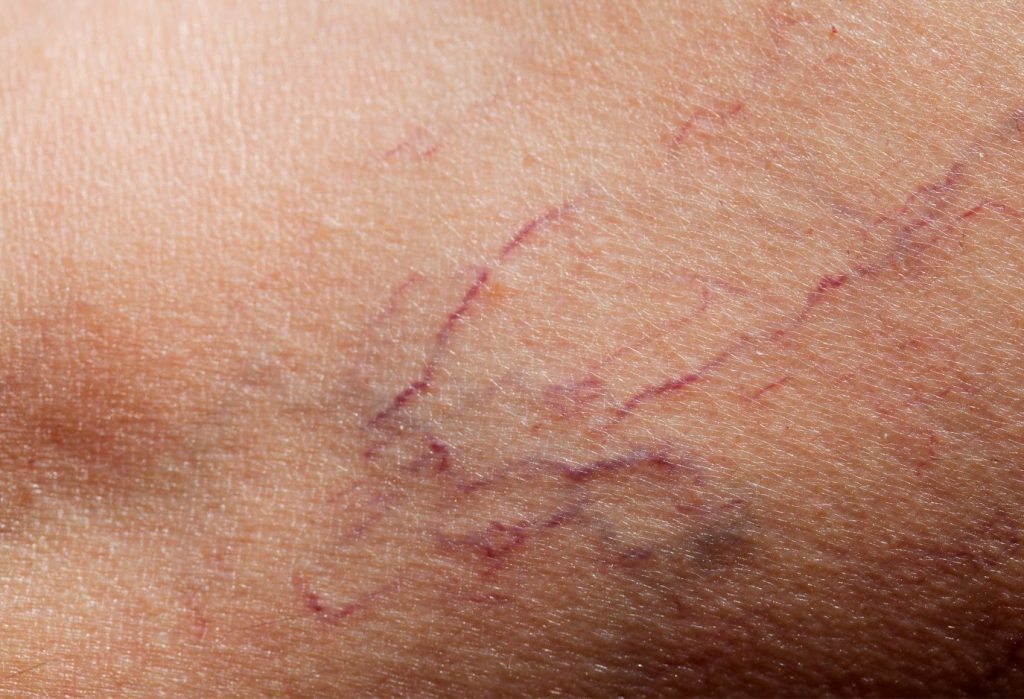 spider veins (telangiectasia). they are thin and purple and red