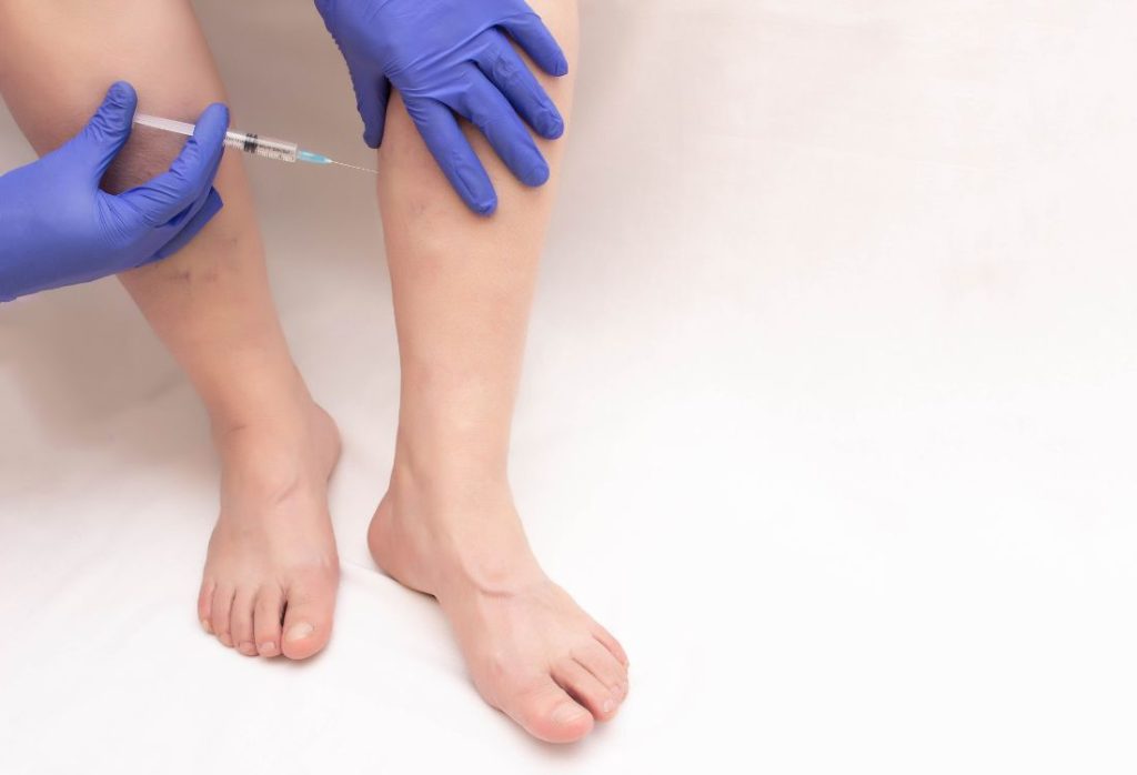 person getting sclerosant injections for spider veins